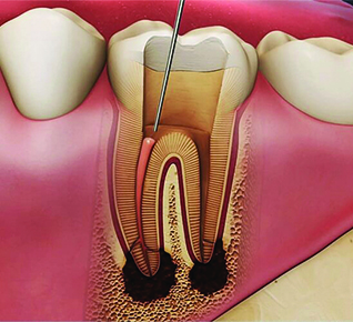 Endodonti